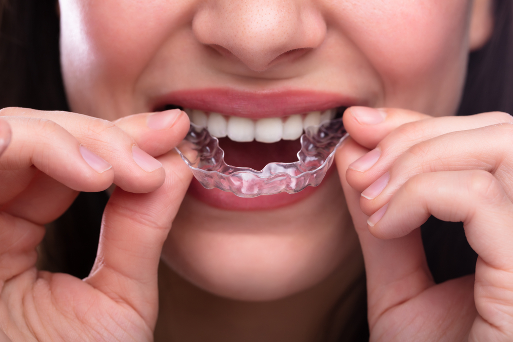 Sinais de Alerta: Quando Buscar Reabilitação Oral 3 Bruxismo nos dentes